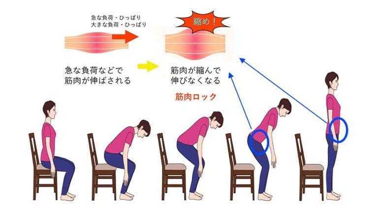 筋肉ロックはからだの防衛反応