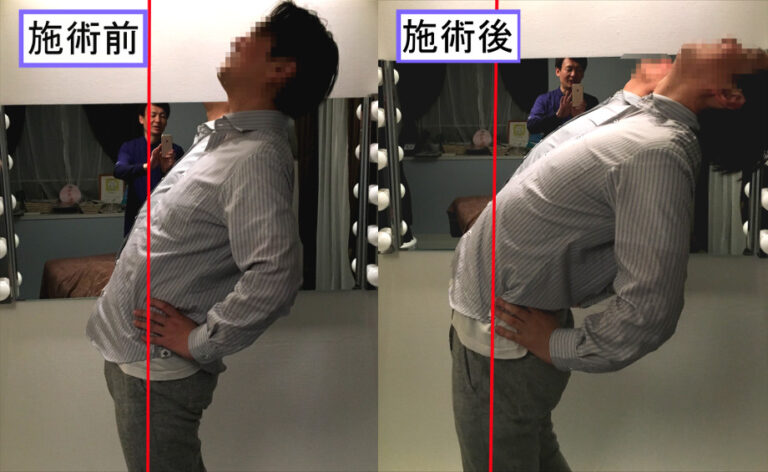 腰痛の施術前後