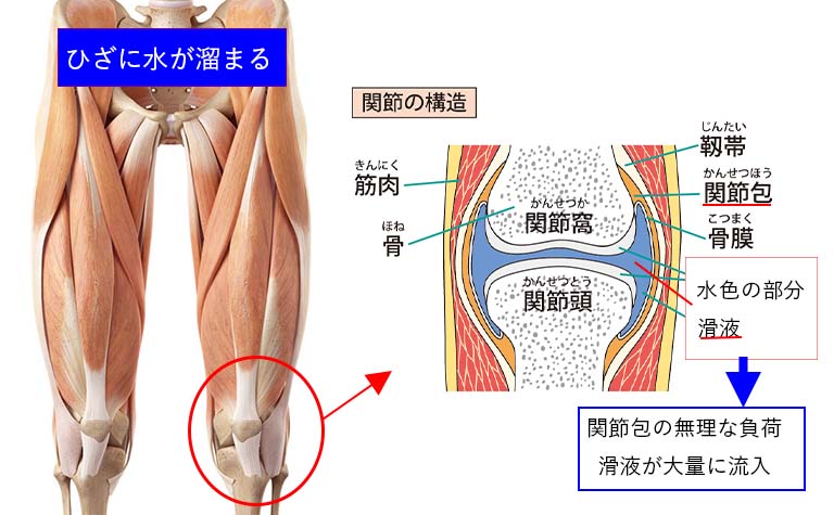 ひざに水が溜まる