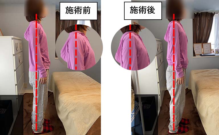 腰痛と呼吸がつらい方の施術前後