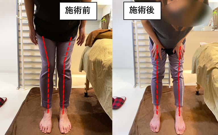 施術前後 立つのがきつい腰痛