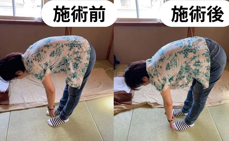 背中の痛み施術前後前屈